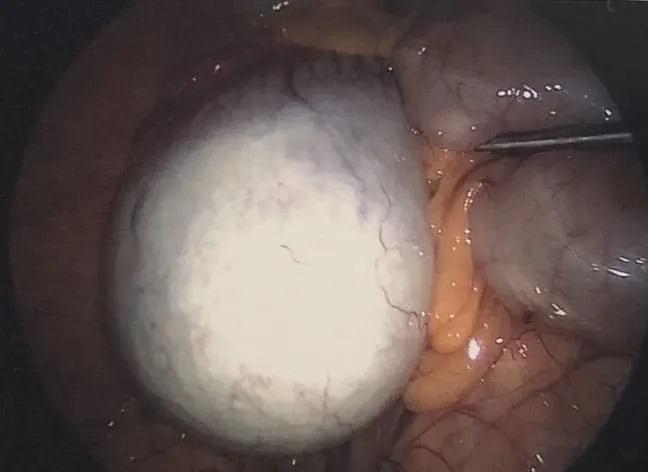 Dermoid Ovarian Cyst 