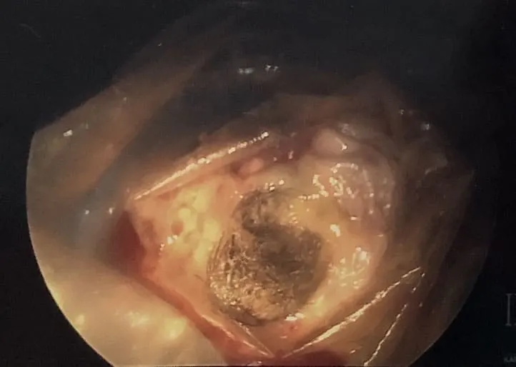 Dermoid ovarian Cyst