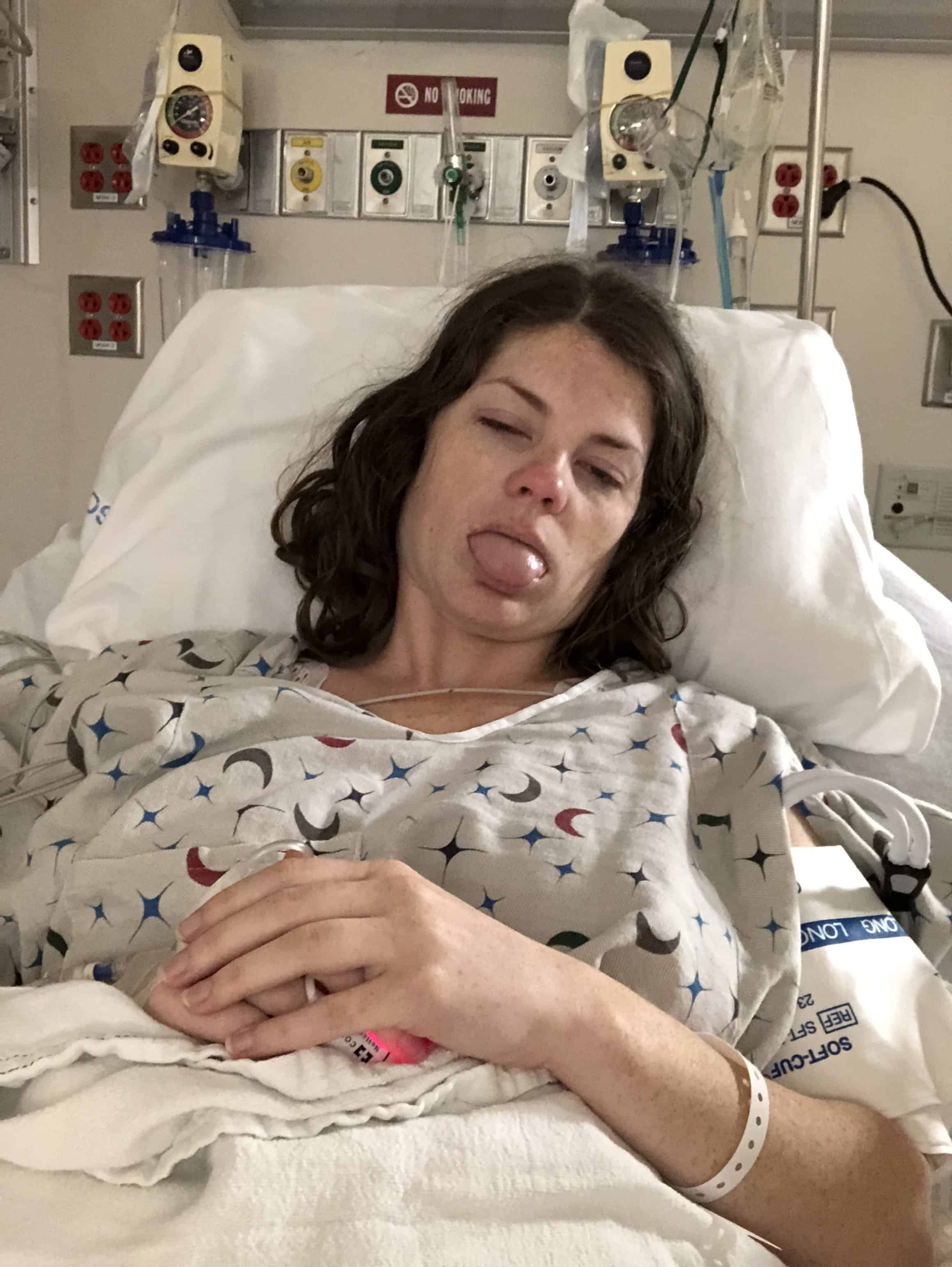 icd 10 code for dermoid cyst in pregnancy