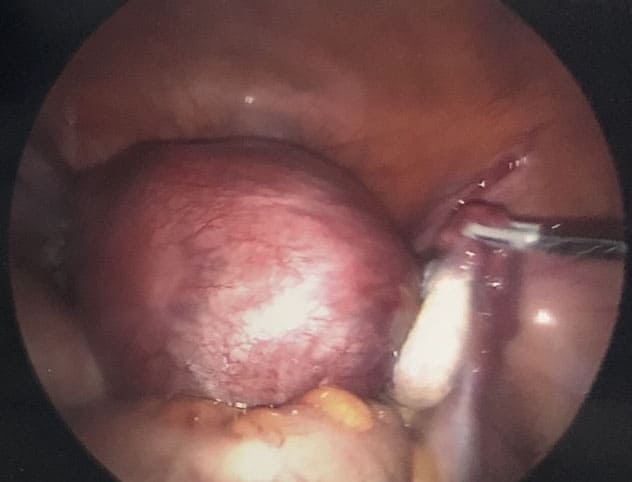 Normal Ovary and Uterus