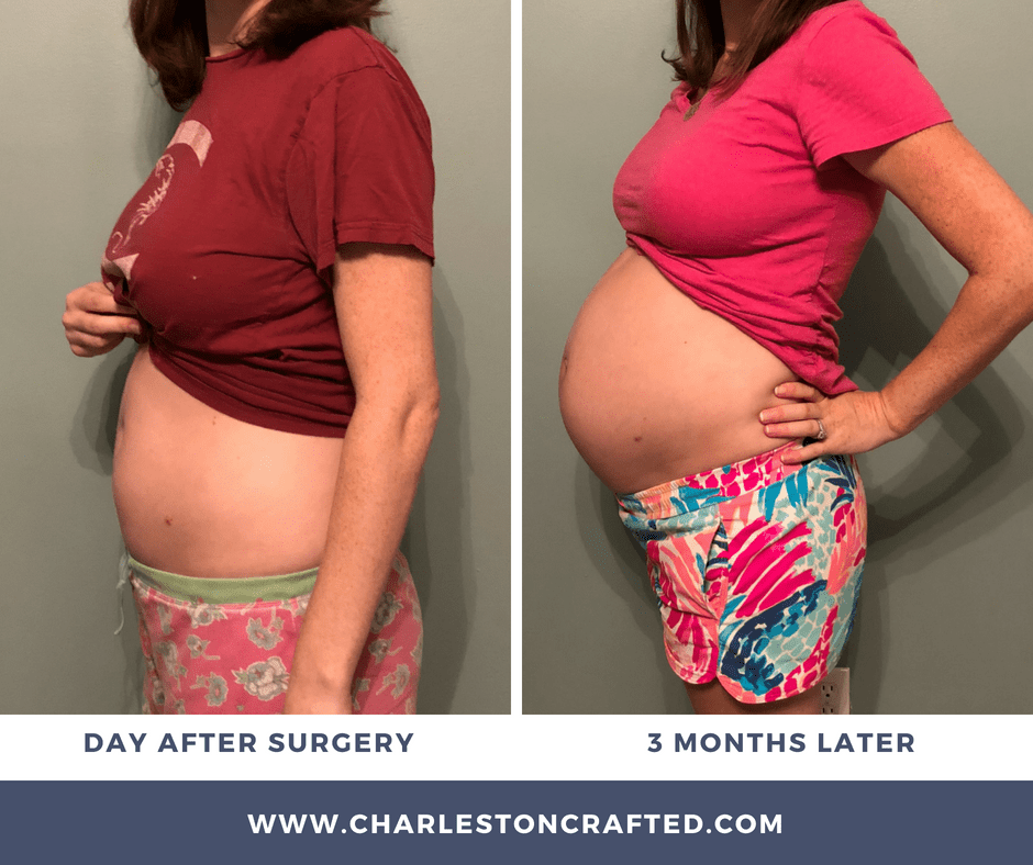 My Experience Having a Dermoid Ovarian Cyst Removed During Pregnancy via Charleston Crafted